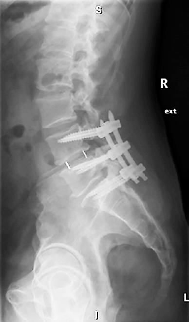Lateral X-ray three months after treatment