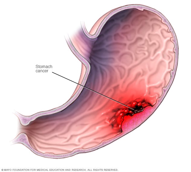 abdominal cancer types