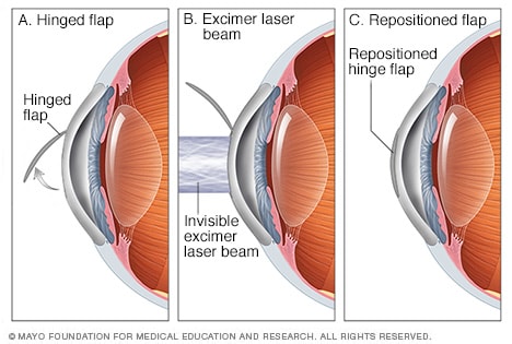 Illustration of LASIK eye surgery 
