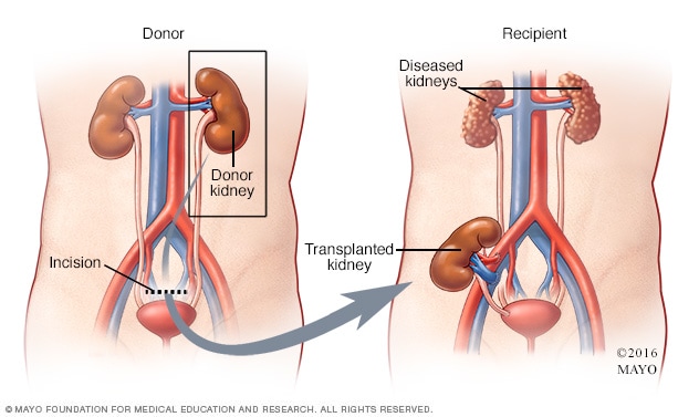 Living kidney donor laparoscopic nephrectomy