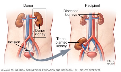 Procedimiento de trasplante de riñón con donante vivo