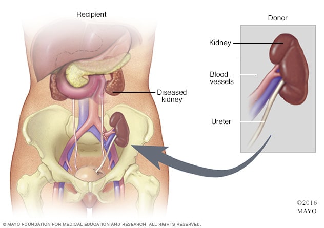 Kidney transplant - Mayo Clinic