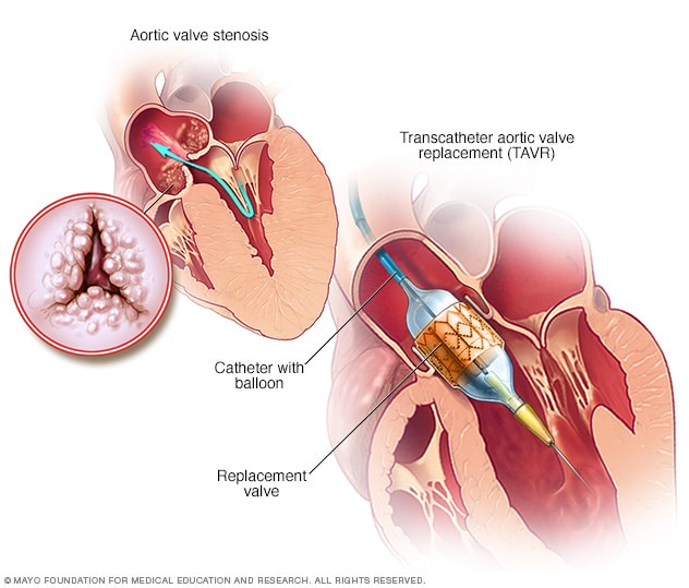 Reemplazo de válvula aórtica transcatéter
