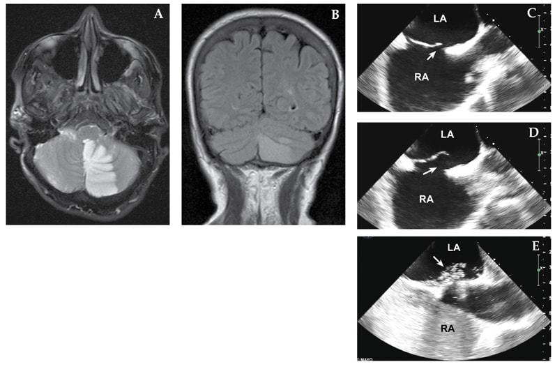 يستخدم التصوير بالرنين المغناطيسي (MRI) والتصوير عبر الصدر لتحديد الثقبة البيضوية الواضحة