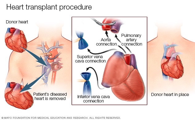 Ilustración de un procedimiento de trasplante de corazón