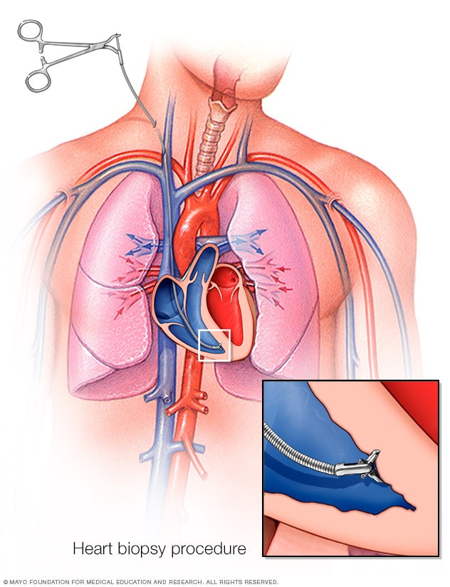 Illustration of heart biopsy