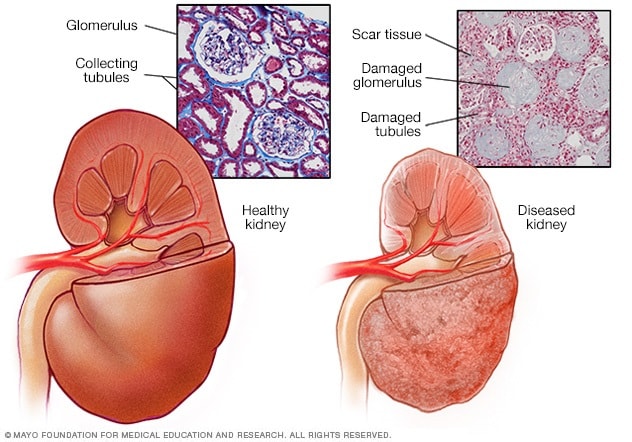 Un rinichi sănătos și un rinichi bolnav