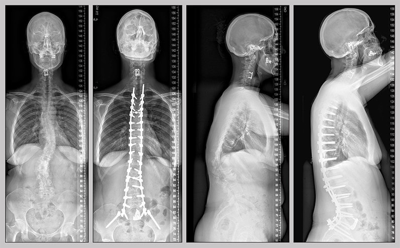 Surgical correction of a double major curve in a woman with scoliosis