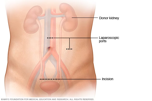 kidney transplant donor scar