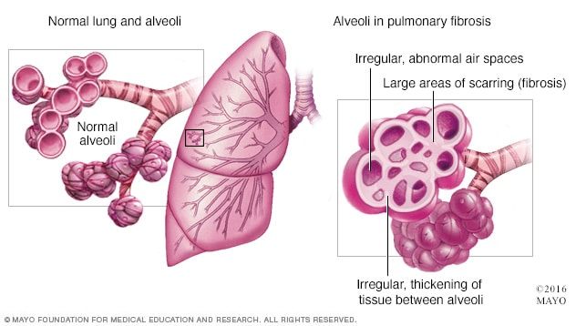 Fibrosis pulmonar