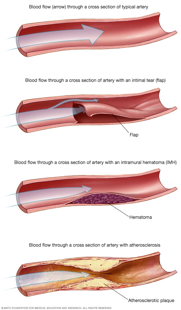 Flujo de sangre en las arterias en la disección espoontánea de la arteria coronaria