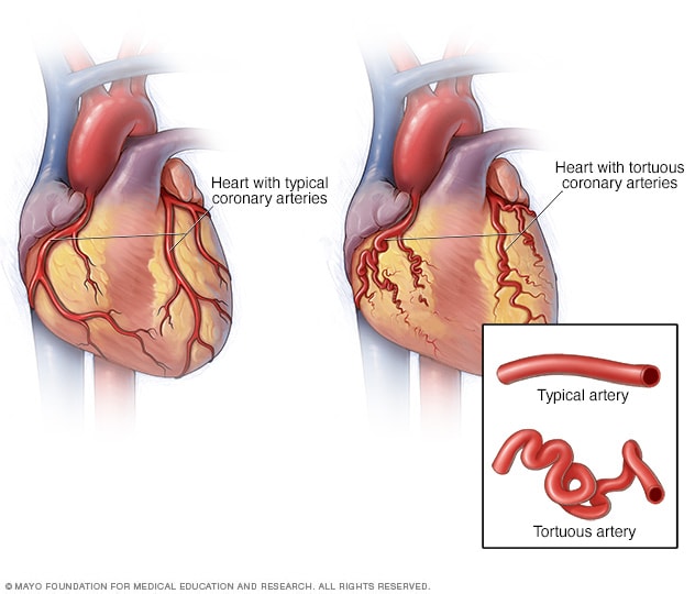 Un corazón normal y uno con arterias tortuosas