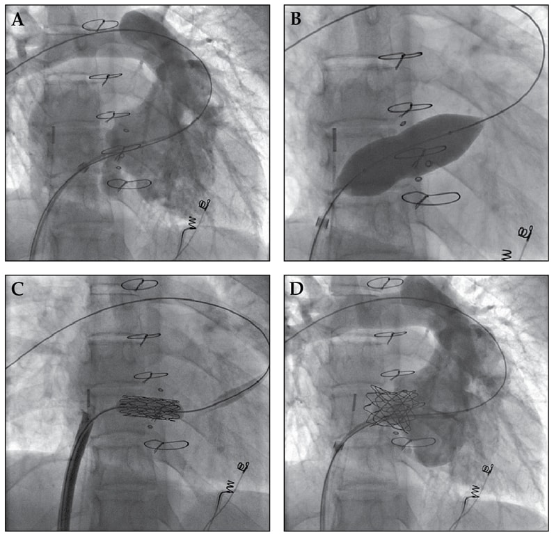 Tricuspid valve-in-valve implantation