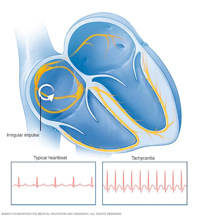 can high blood pressure cause fast heartbeat