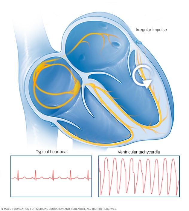 Ventricular tachycardia heartbeat