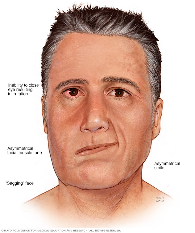 Ramsay Hunt syndrome - Symptoms and causes - Mayo Clinic