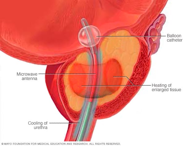 Termoterapia transuretral con microondas