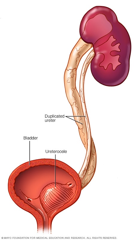 A cutaway view of the bladder with a ureterocele inside and two ureters coming into the bladder.