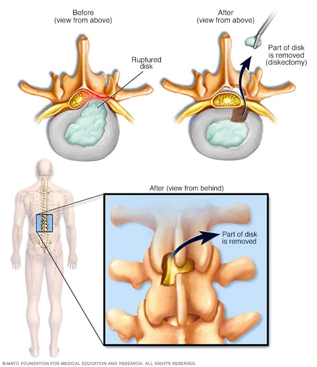 Extracción de una porción de hernia de disco intervertebral