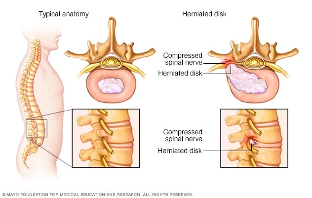 Herniated Disk Symptoms And Causes Mayo Clinic