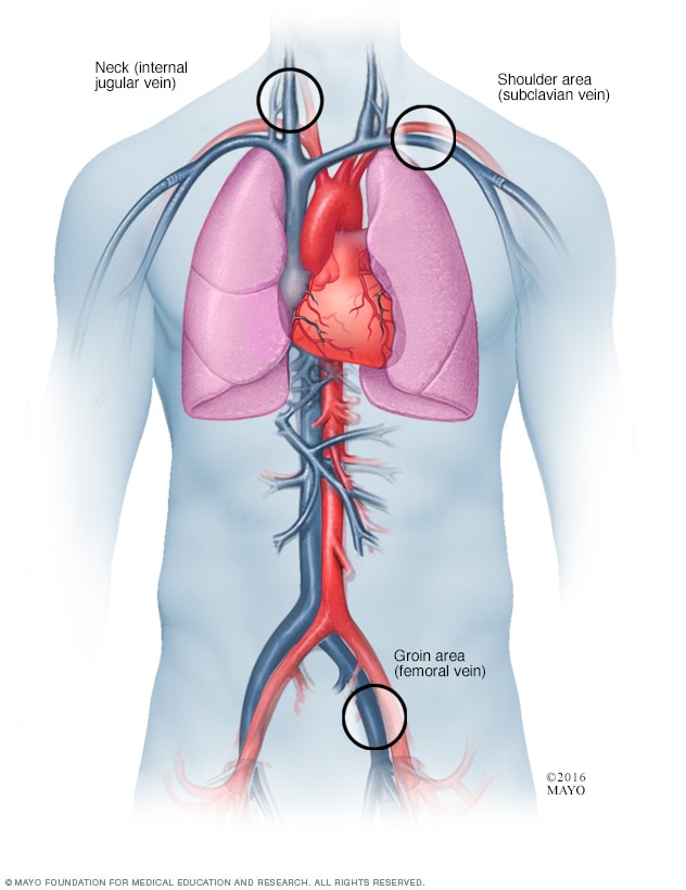 What Are The Two Types Of Cardiac Ablation
