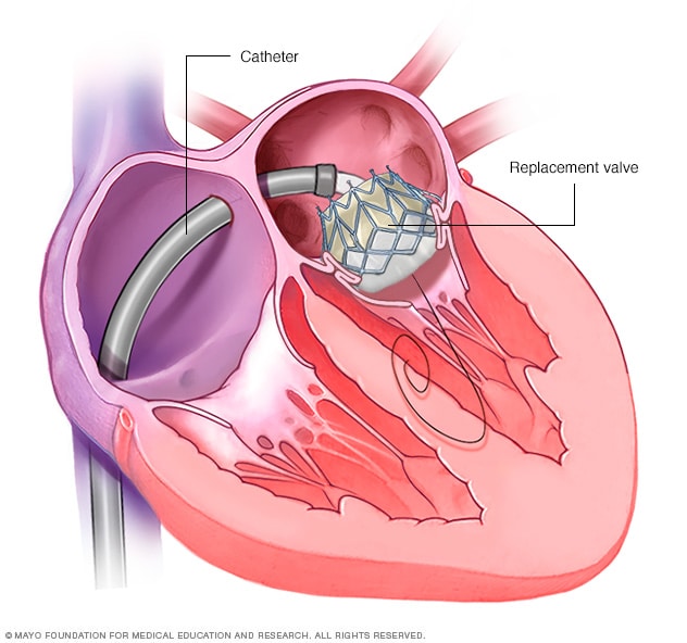 Minimally invasive heart surgery