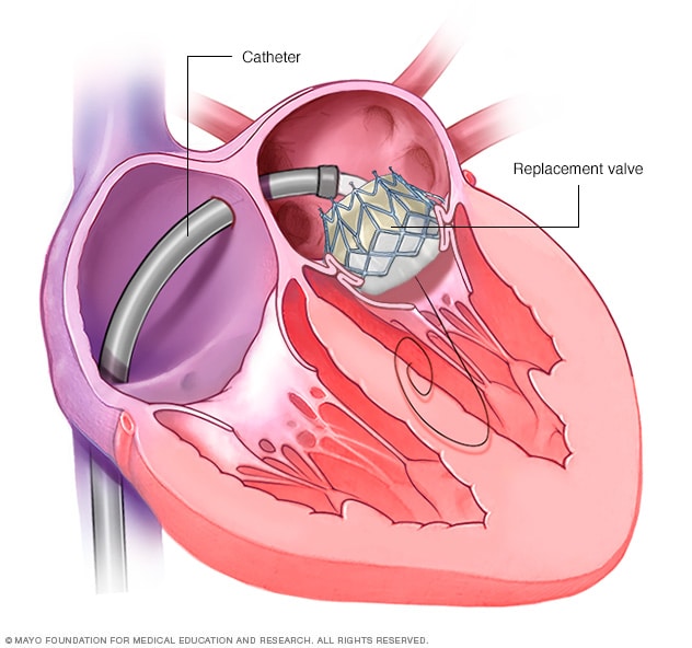 mitral valve replacement