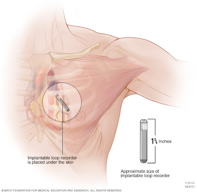 Implantable loop recorder: A heart monitoring device - Type - Mayo Clinic