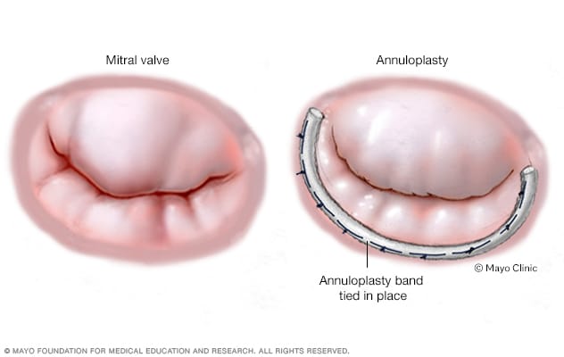 Mitral Valve Repair Surgery