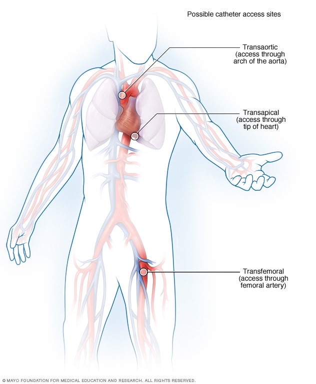 Catheter access sites in transcatheter aortic valve replacement