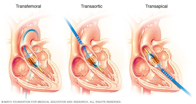 Transcatheter Aortic Valve Replacement Tavr Mayo Clinic