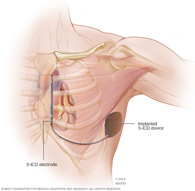 Desfibrilador cardioversor implantable subcutáneo