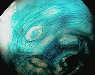 جزء مصبوغ من القولون أثناء التلوين التنظيري