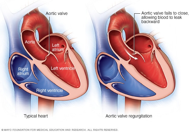 Aorta And Aortic Valve