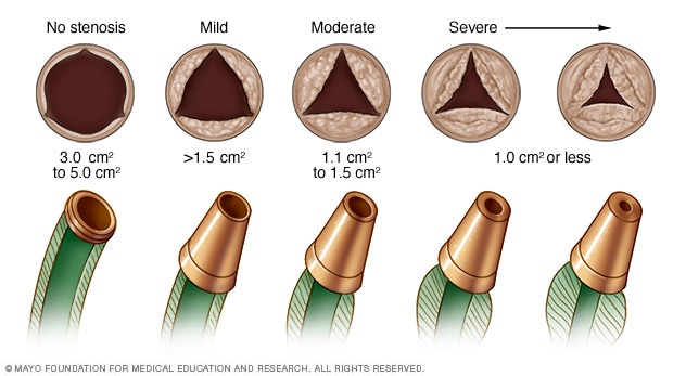 Narrowing of aortic valve in aortic valve stenosis
