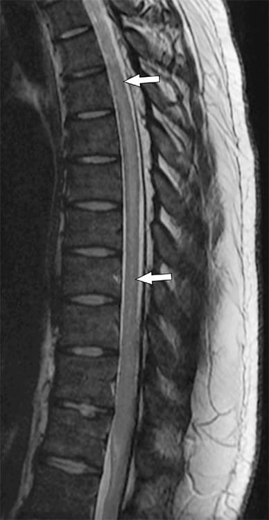 تشوهات في الإشارة الطويلة في الحبل الشوكي