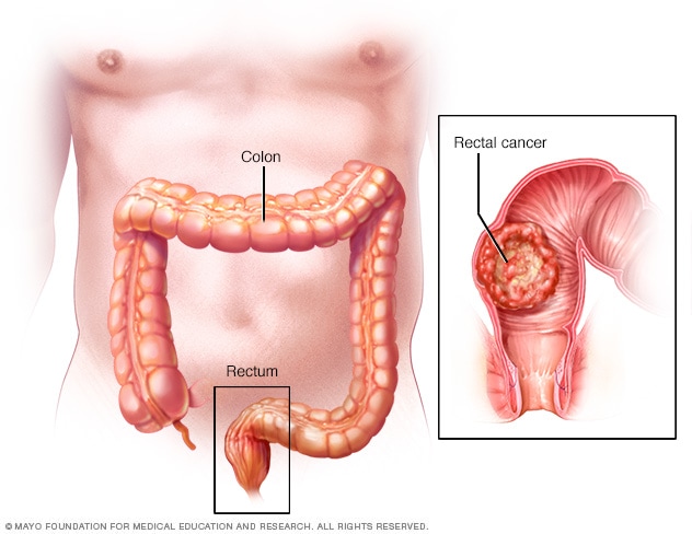 Cauze și simptome ale cancerului rectal