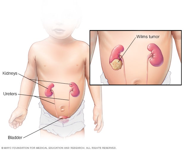 abdominal cancer pediatric)