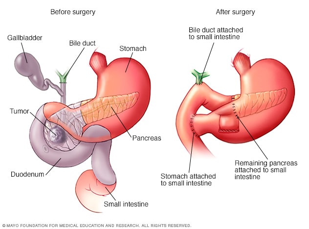 Whipple Procedure Mayo Clinic