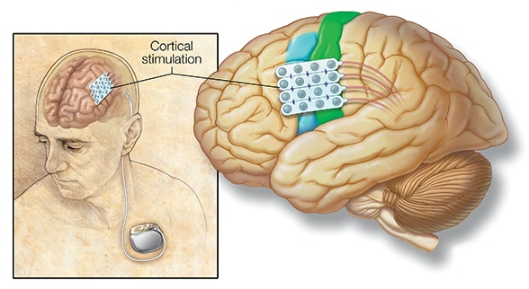 Electrodes in the brain connect to a generator implanted in the chest