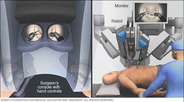 Robot-assisted heart surgery - Mayo Clinic