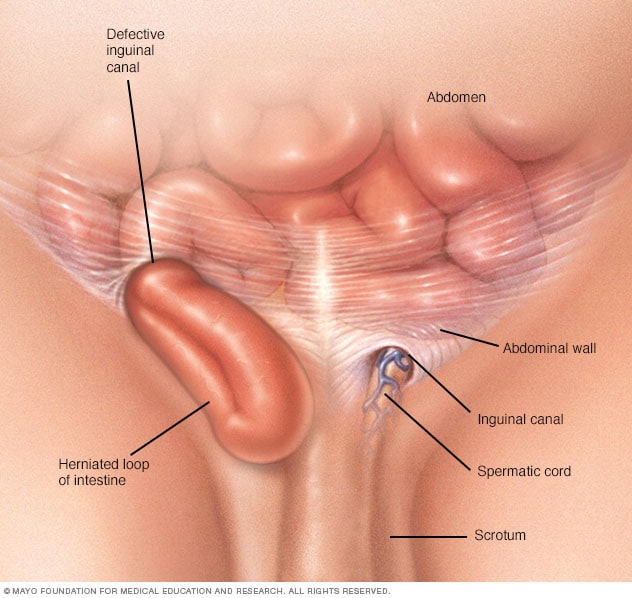 Inguinal hernia - Mayo Clinic