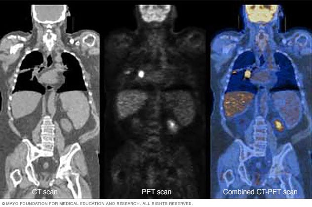 Images of PET scan combined with CT scan