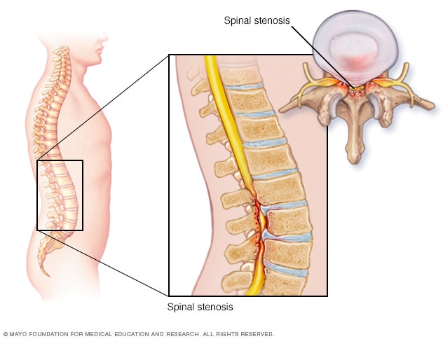 Spinal stenosis - Symptoms and causes - Mayo Clinic