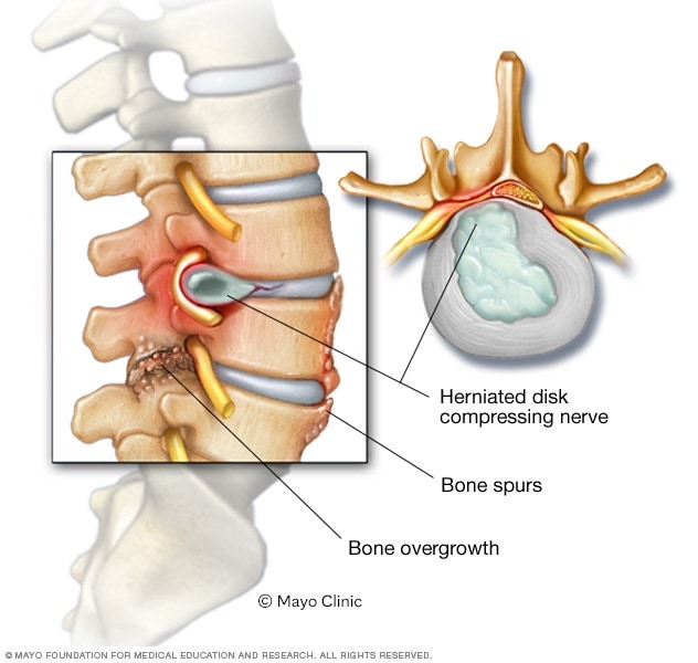 Espolones óseos y hernias discales en la columna vertebral