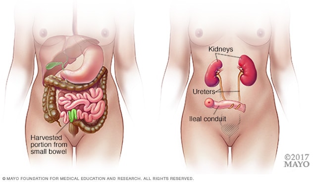 Porción del intestino delgado utilizada para una cirugía del conducto ileal