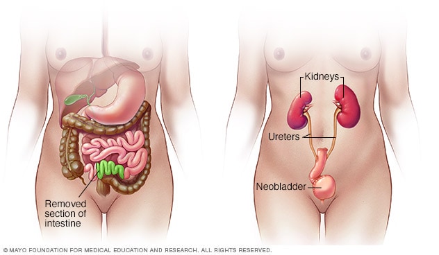 Part of small intestine used for neobladder reconstruction