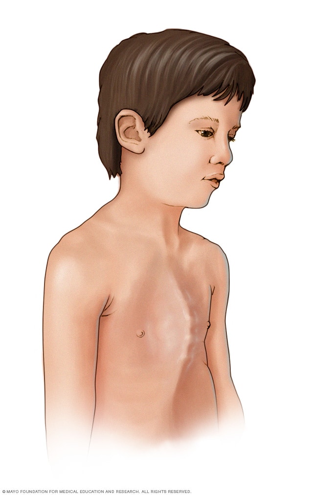 طفل يعاني عظام صدر بارزة للخارج