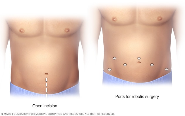 Location of incisions for open prostatectomy compared with robotic prostatectomy