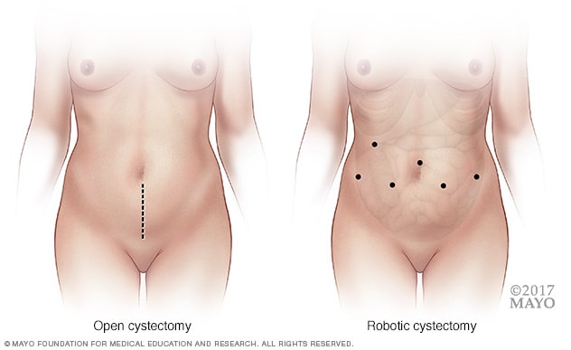 Comparación de la ubicación de las incisiones en una cistectomía abierta y una cistectomía robótica